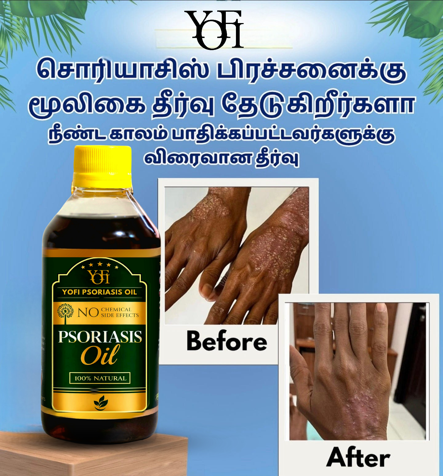 YOFI Herbal Psoriasis -Clearing Oil