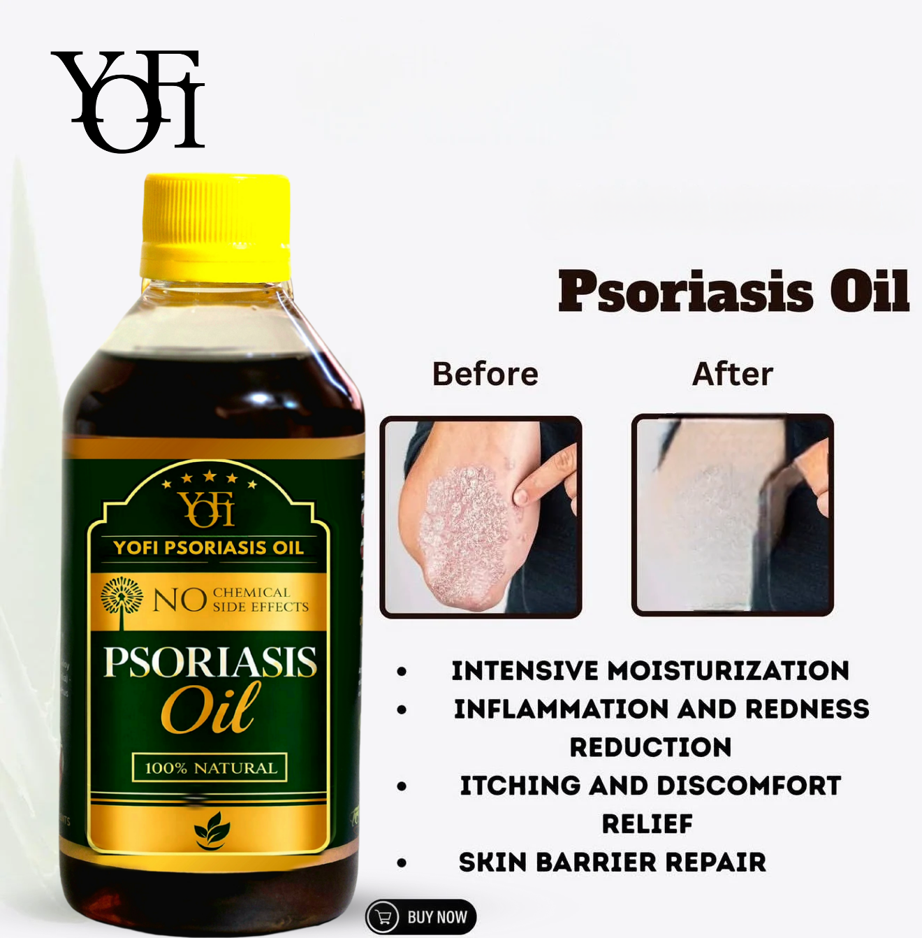 YOFI Herbal Psoriasis -Clearing Oil