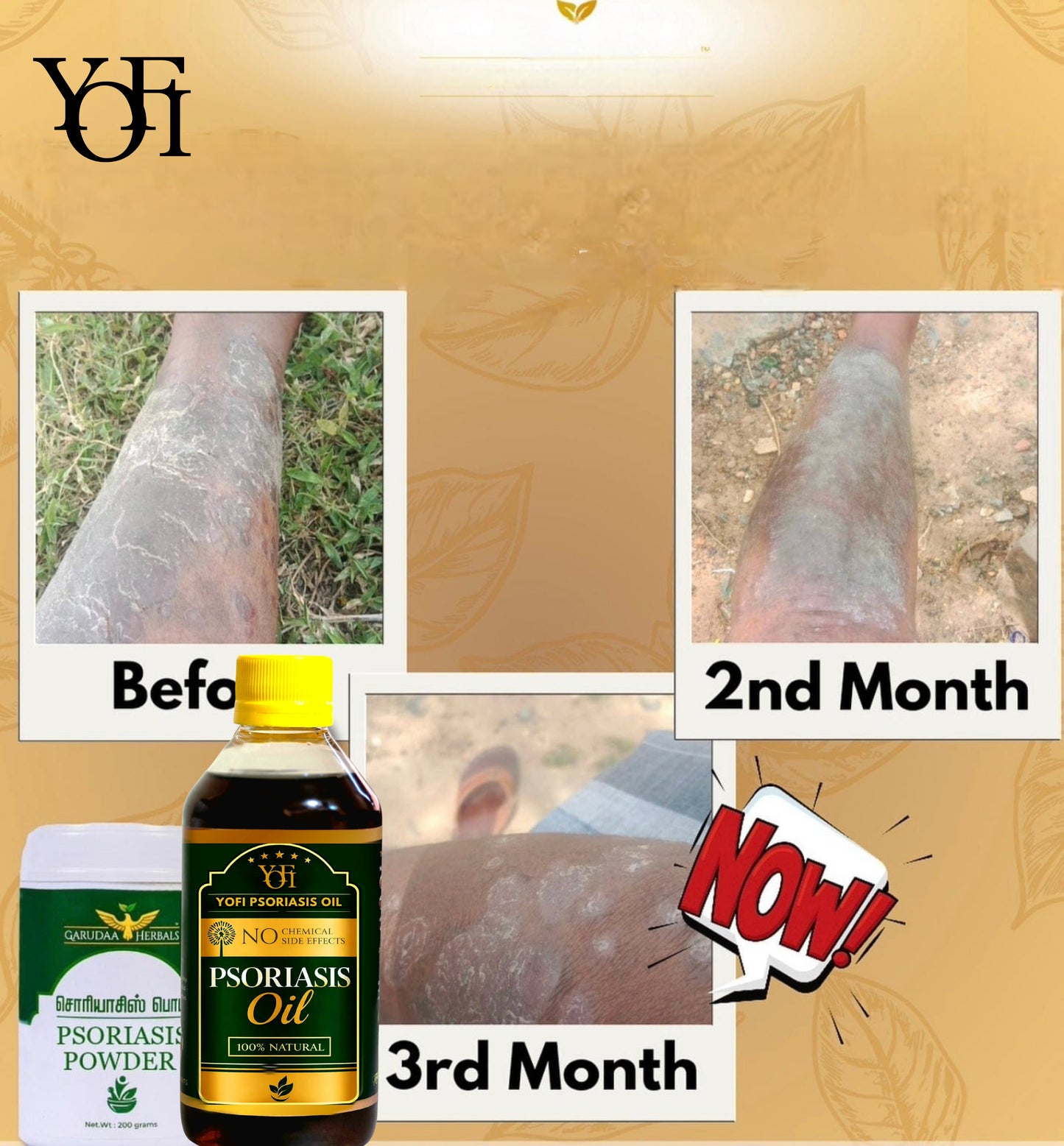 YOFI Herbal Psoriasis -Clearing Oil